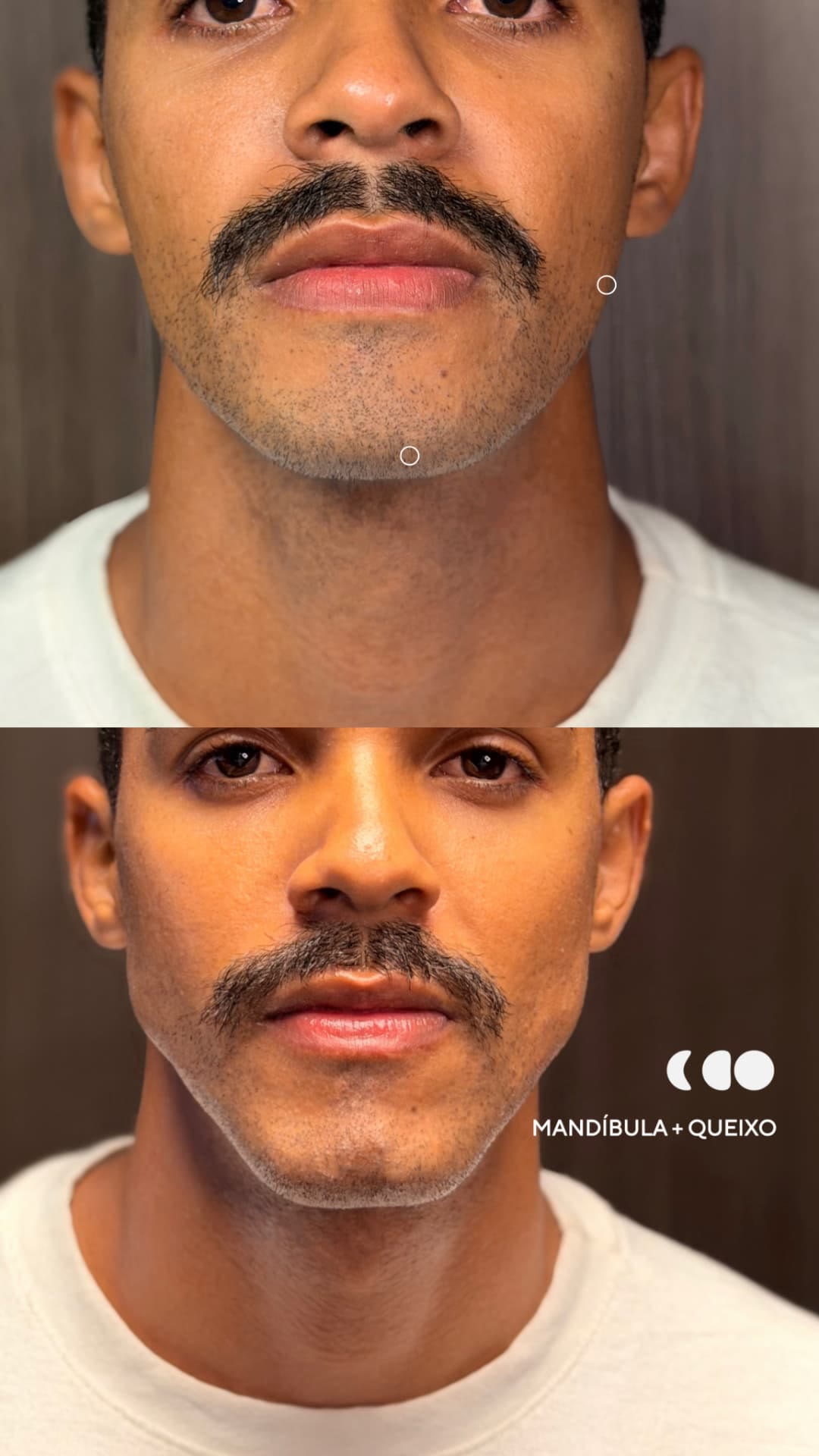 Antes (em cima) e depois (embaixo) — Preenchimento com ácido hialurônico, mandíbula e queixo (mento)