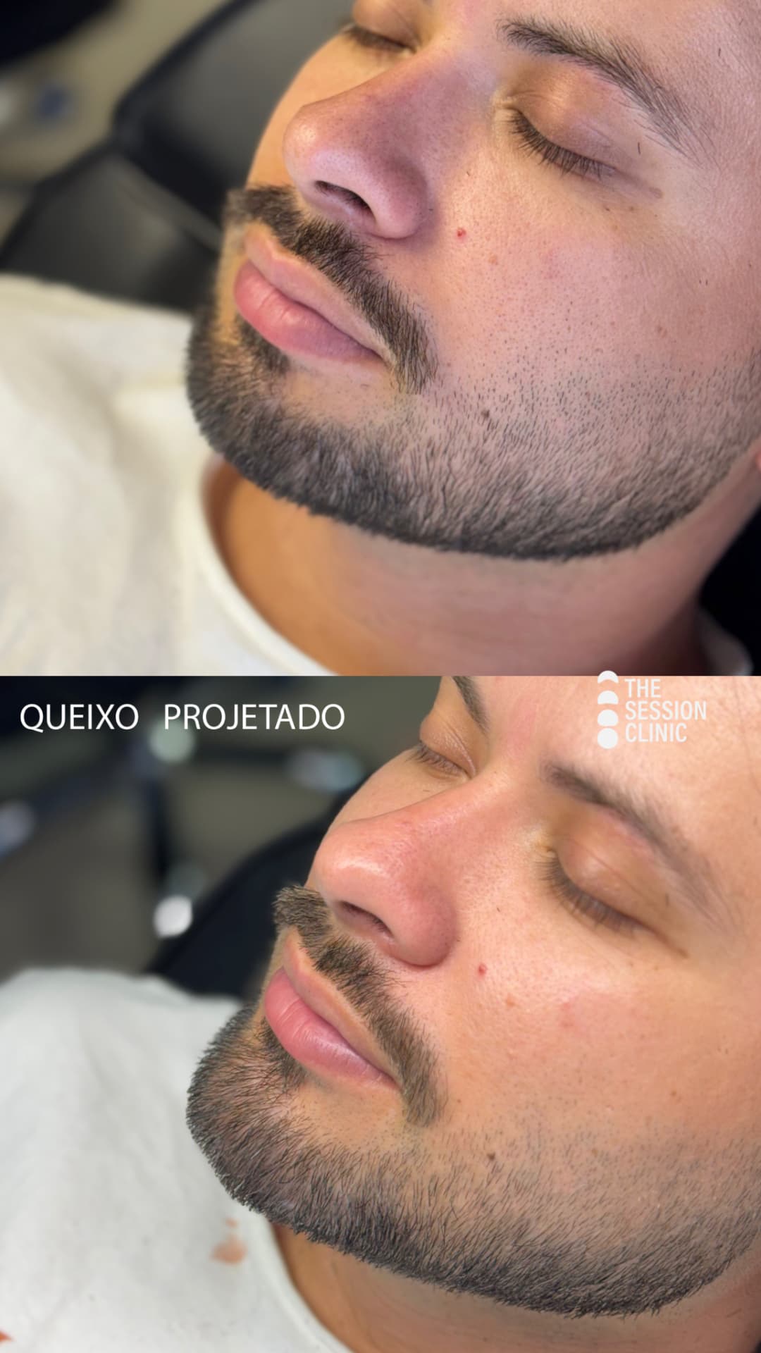 Antes (em cima) e depois (embaixo) — Preenchimento com ácido hialurônico, queixo (mento)