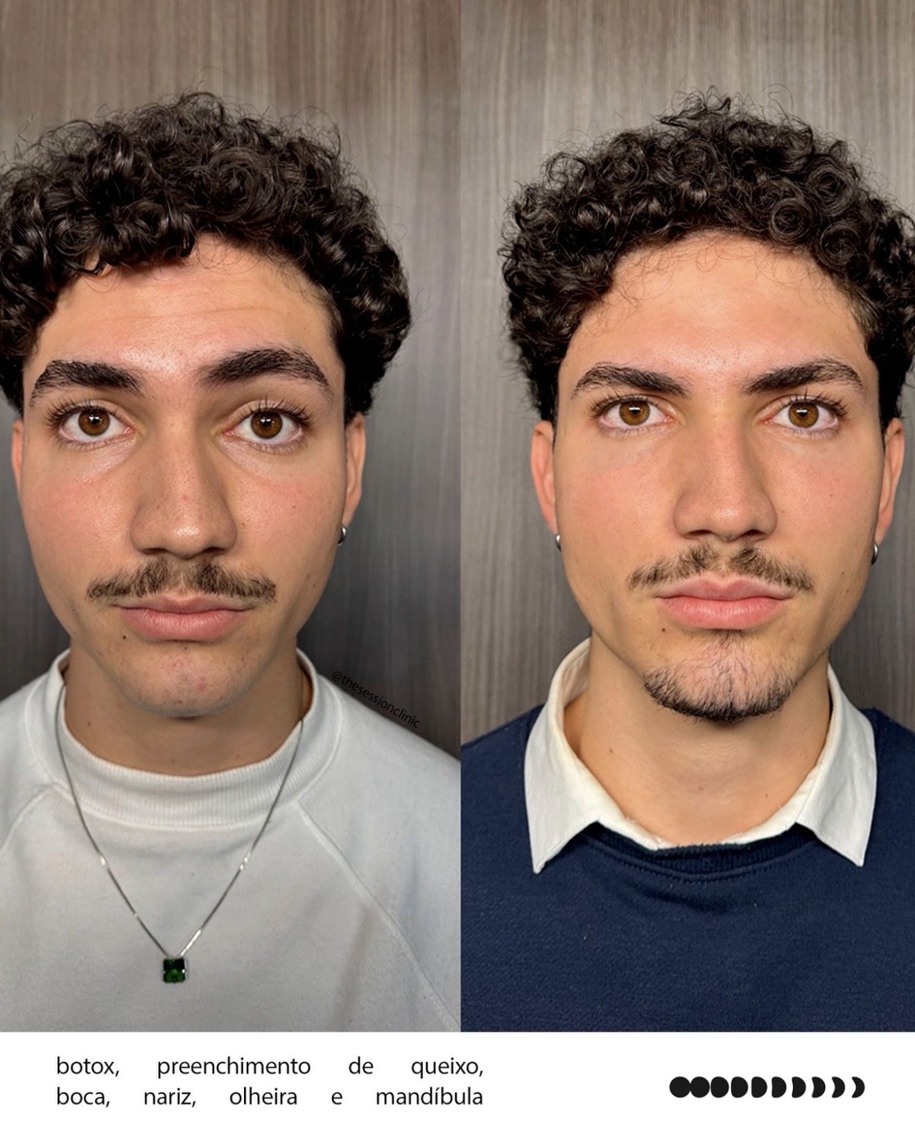 Antes e depois — full face