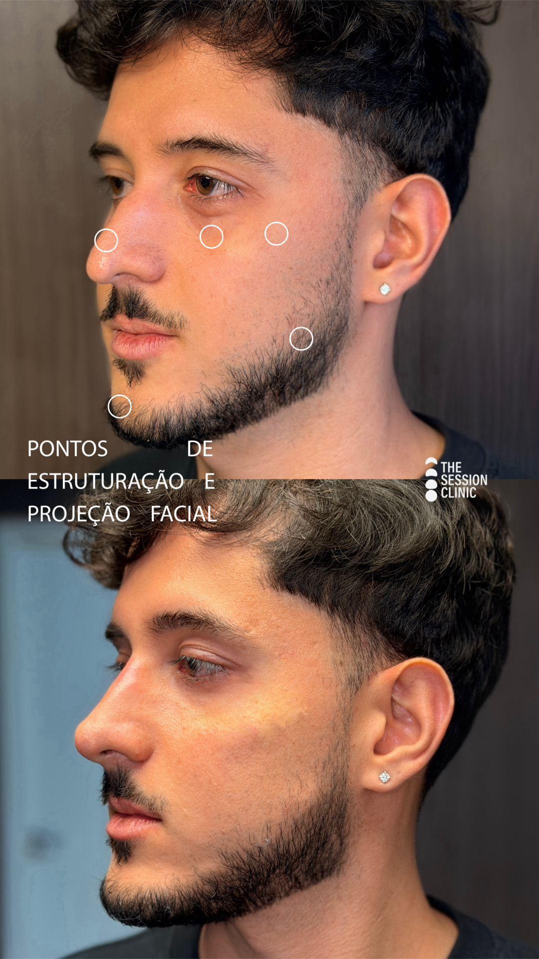 Antes e depois — full face (estruturação e projeção facial)
