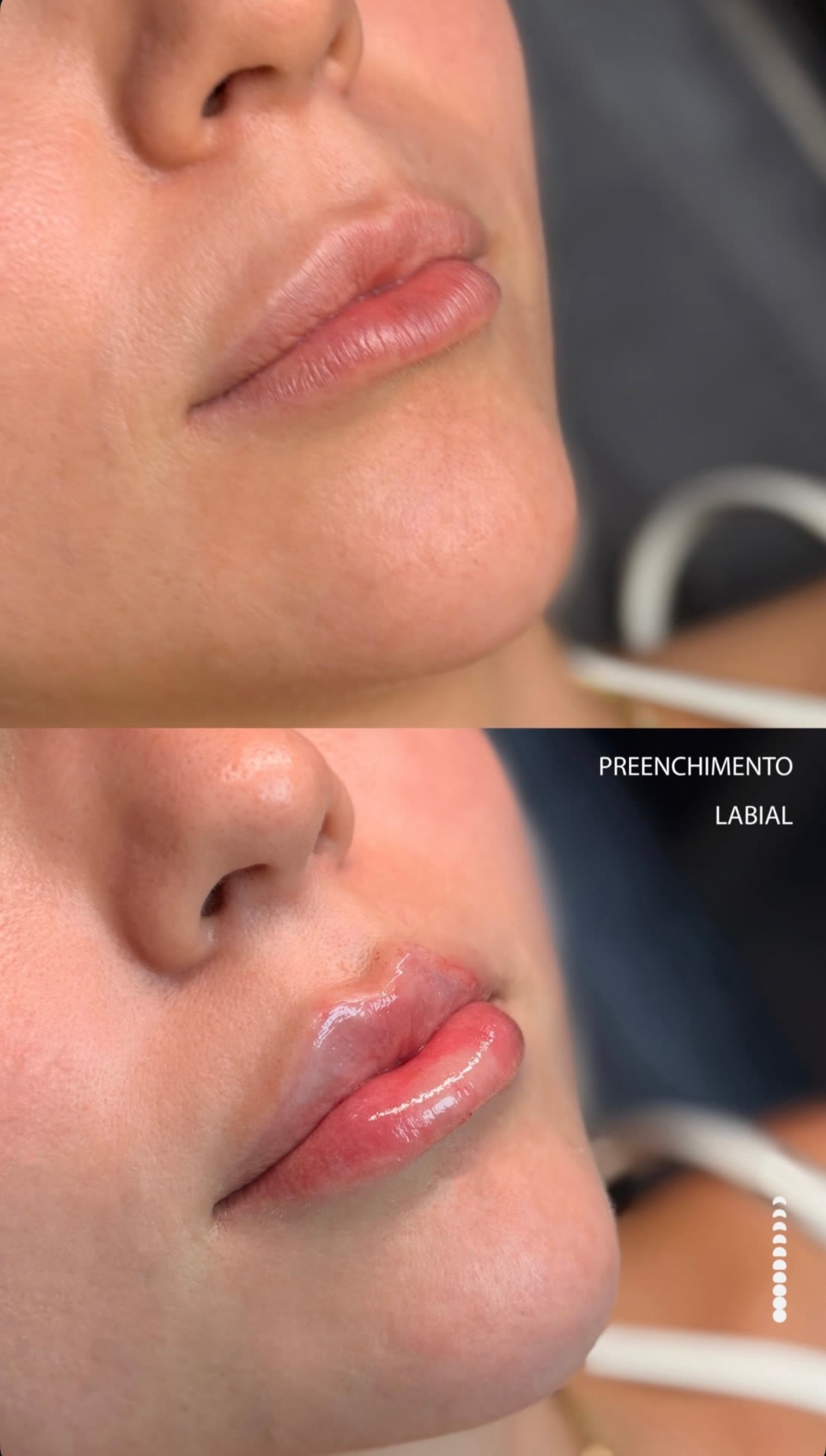 Antes (em cima) e depois (embaixo) — Preenchimento com ácido hialurônico, lábios