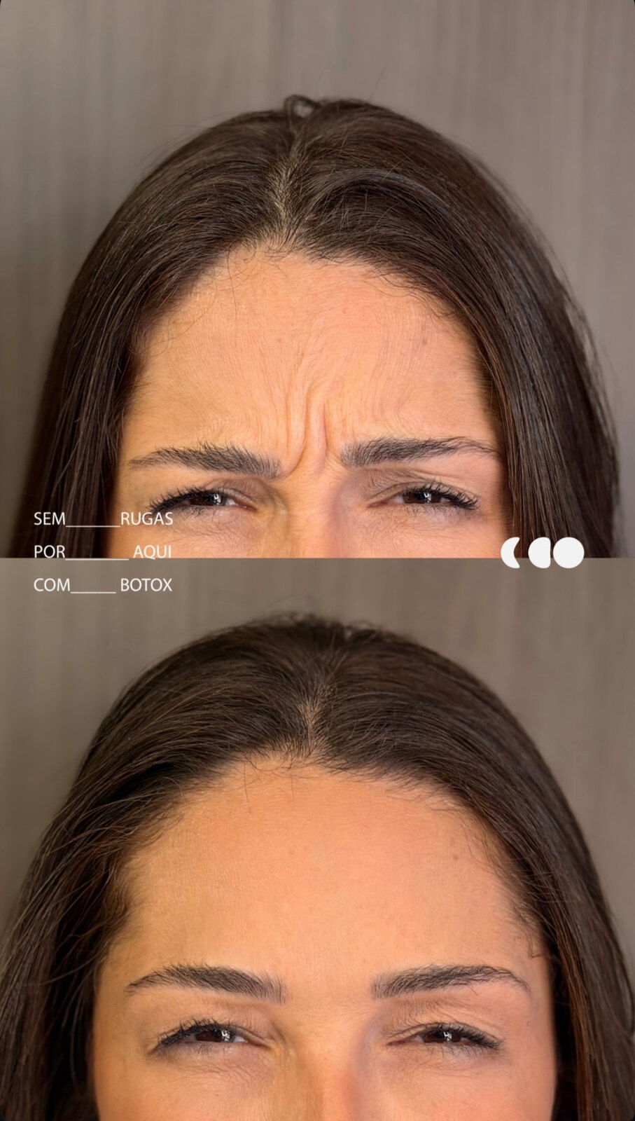 Antes (em cima) e depois (embaixo) — Toxina botulínica, entre as sobrancelhas (glabela)
