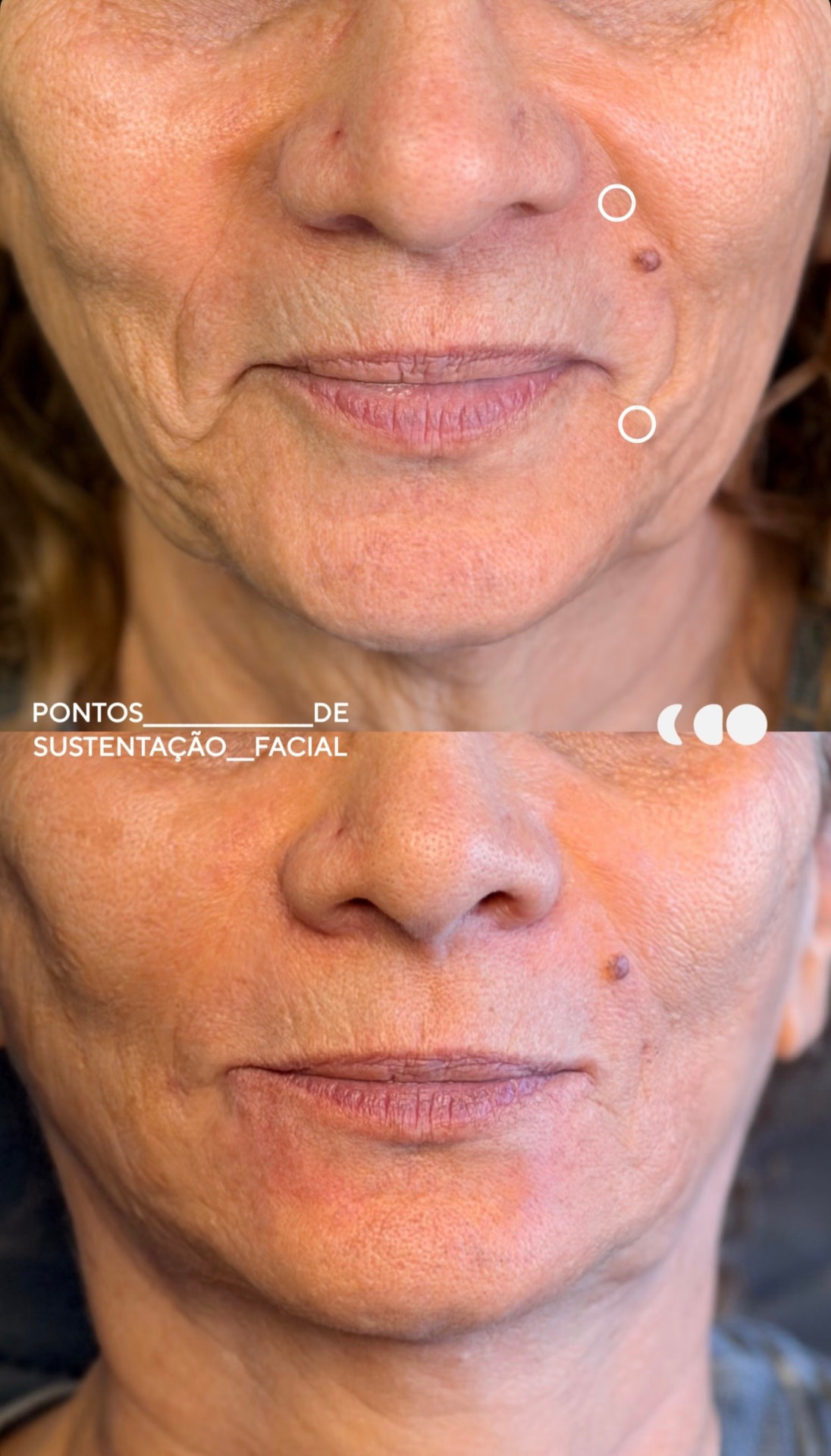 Antes (em cima) e depois (embaixo) — Preenchimento com ácido hialurônico, sustentação malar (pontos de sustentação facial)