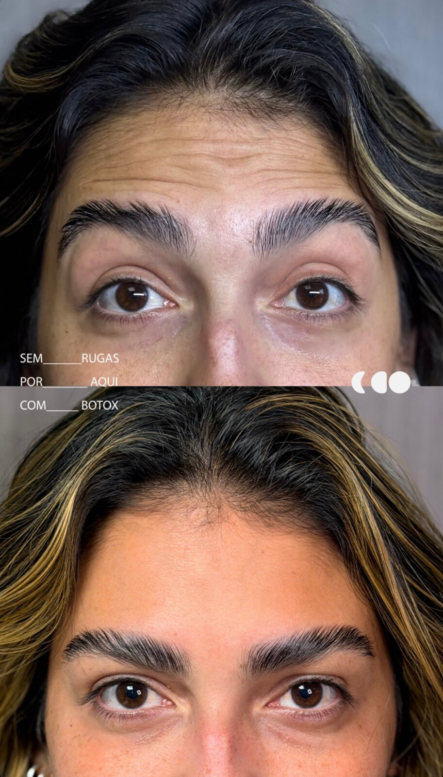 Antes (em cima) e depois (embaixo) — Toxina botulínica, testa