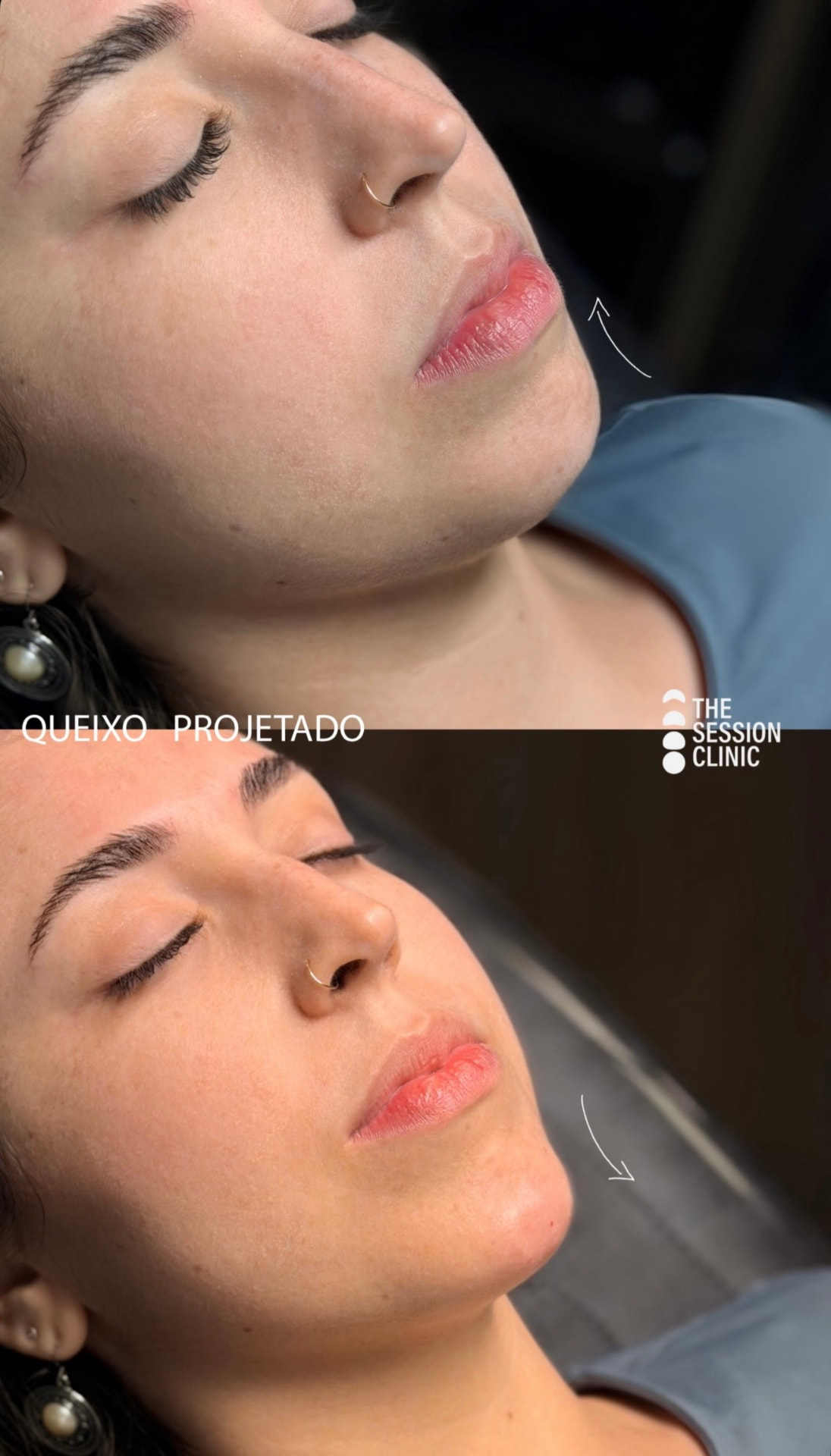 Antes (em cima) e depois (embaixo) — queixo (mento)