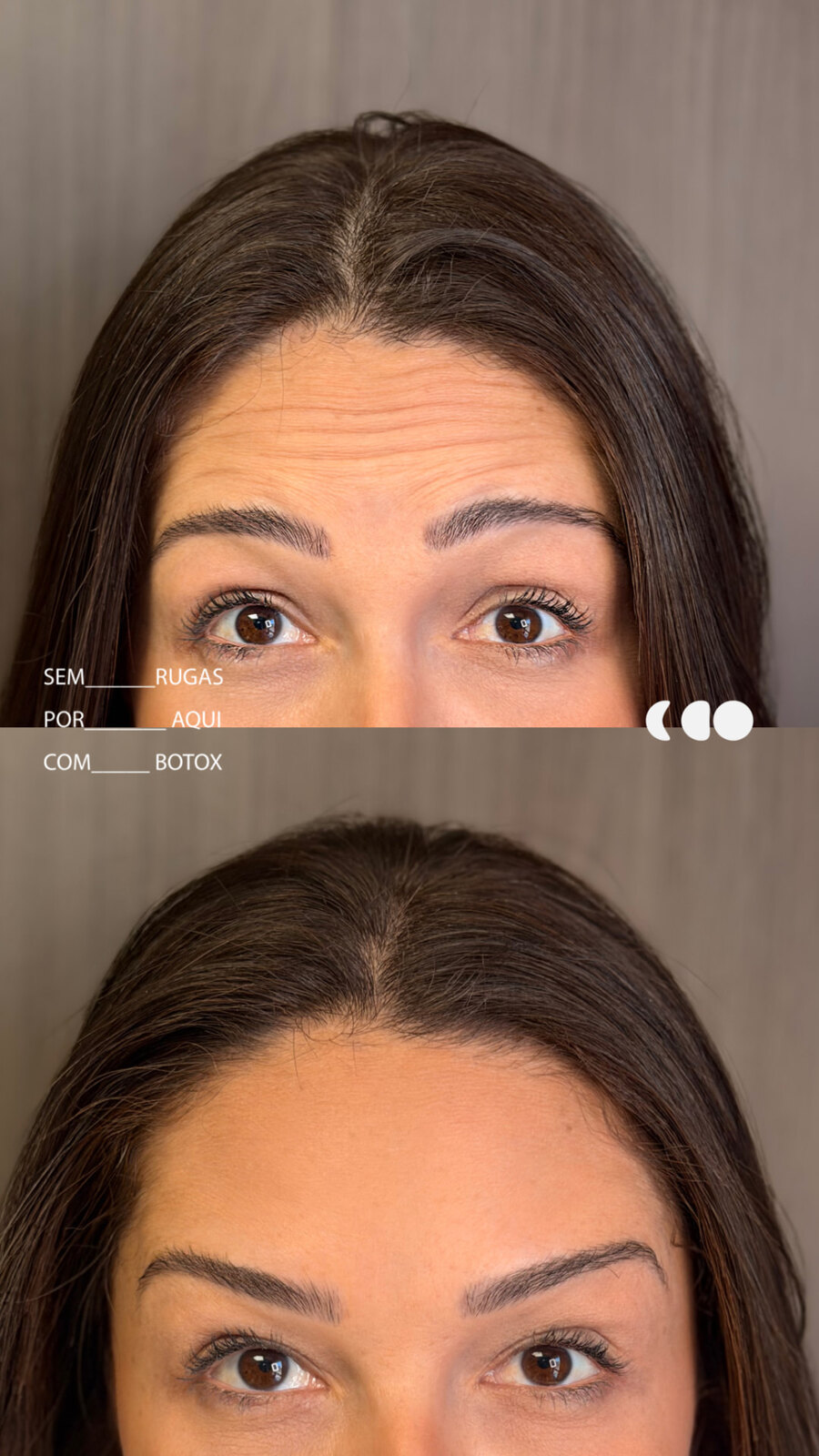 Antes (em cima) e depois (embaixo) — Toxina botulínica, testa