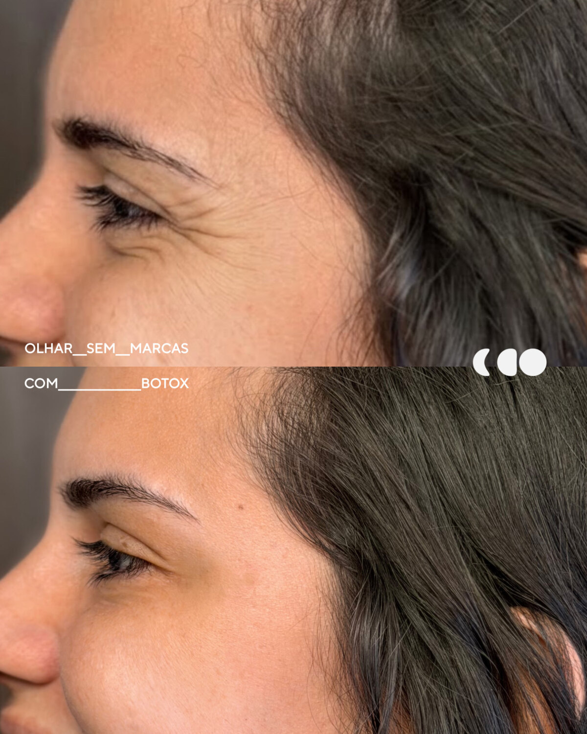 Antes (em cima) e depois (embaixo) — Toxina botulínica, região dos olhos