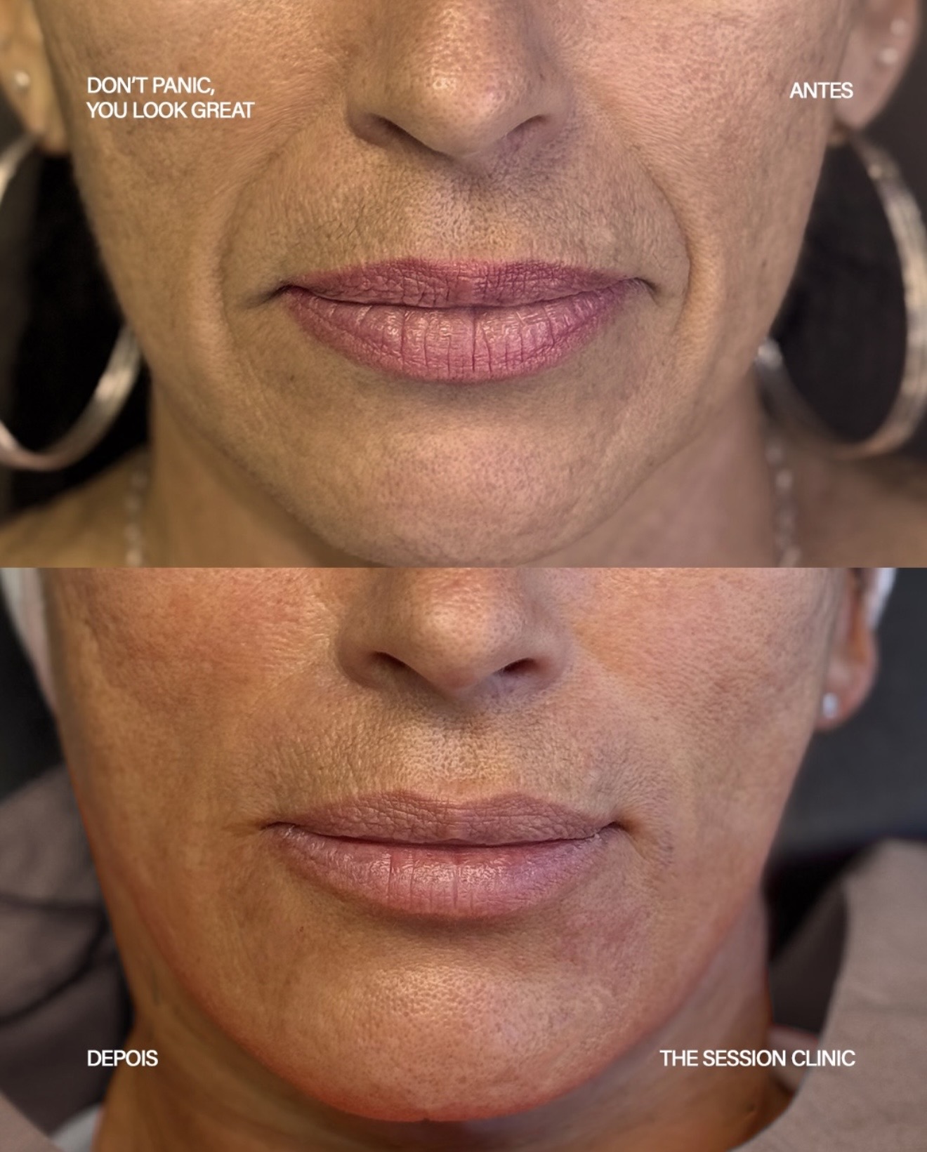 Antes (em cima) e depois (embaixo) — Preenchimento com ácido hialurônico, bigode chinês (sulco nasogeniano)