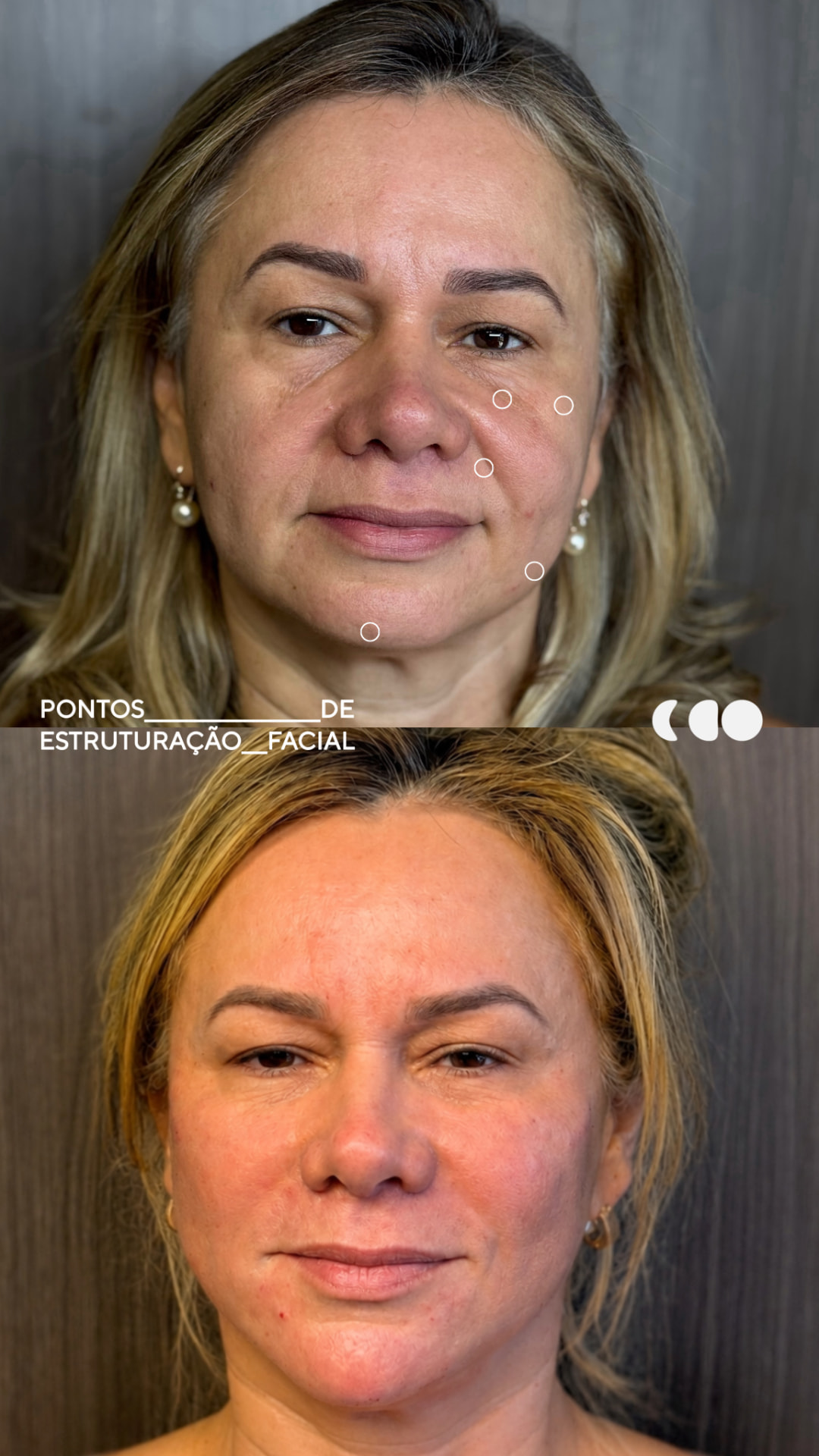 Antes e depois — full face (estruturação facial)