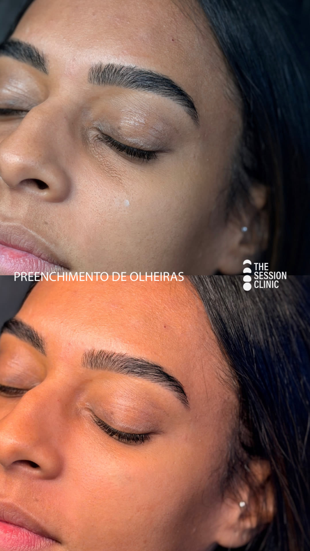 Antes (em cima) e depois (embaixo) — Preenchimento com ácido hialurônico, olheiras