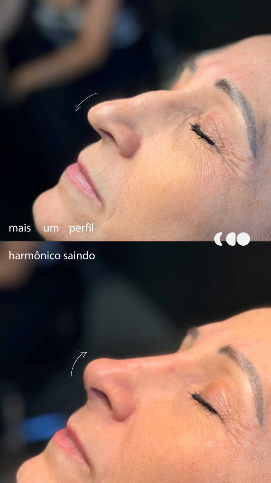 Antes (em cima) e depois (embaixo) — Preenchimento com ácido hialurônico, nariz (rinomodelação)
