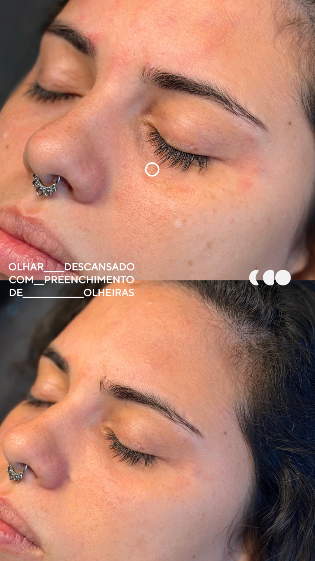 Antes (em cima) e depois (embaixo) — Preenchimento com ácido hialurônico, olheiras