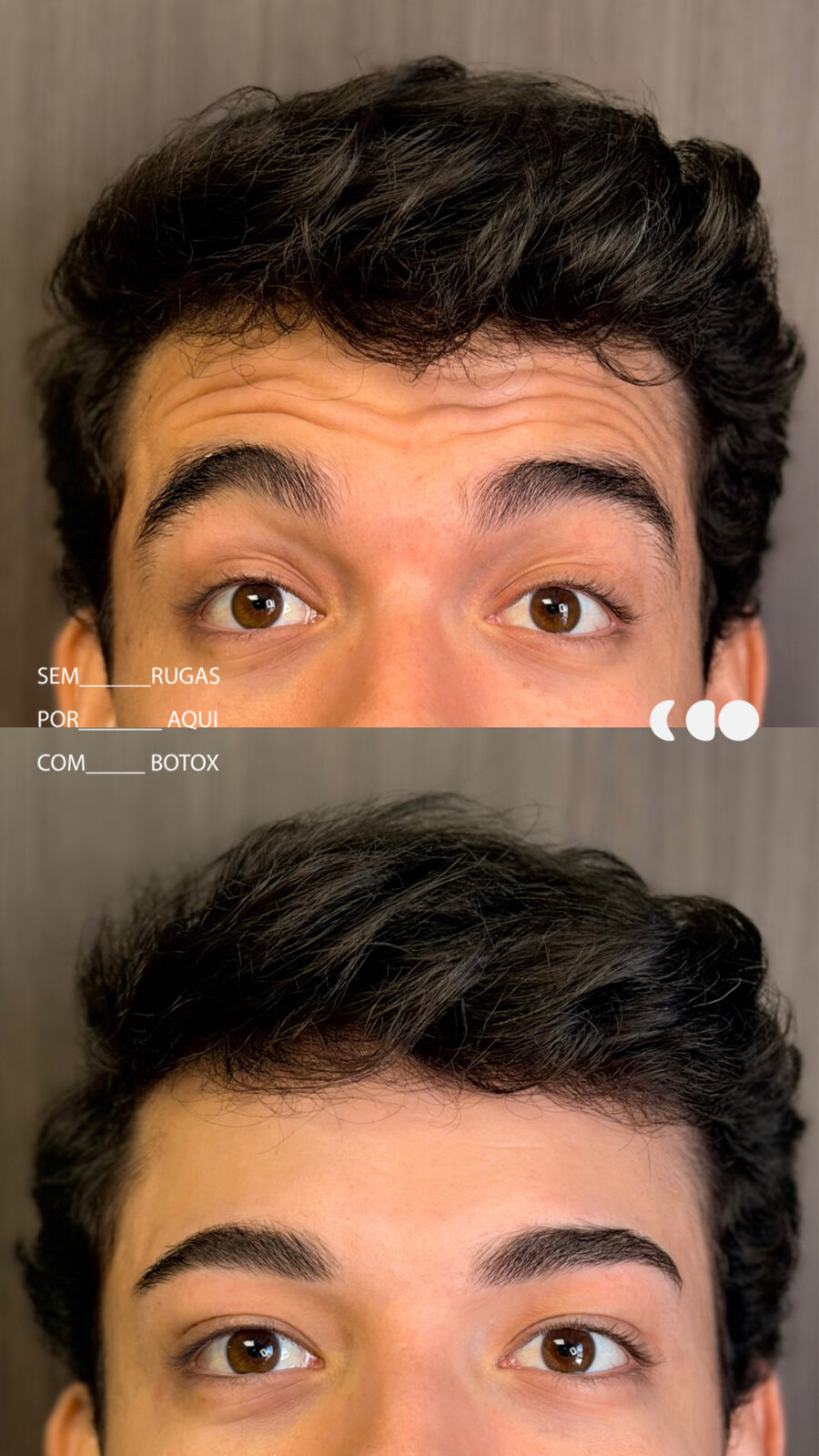 Antes (em cima) e depois (embaixo) — Toxina botulínica, testa