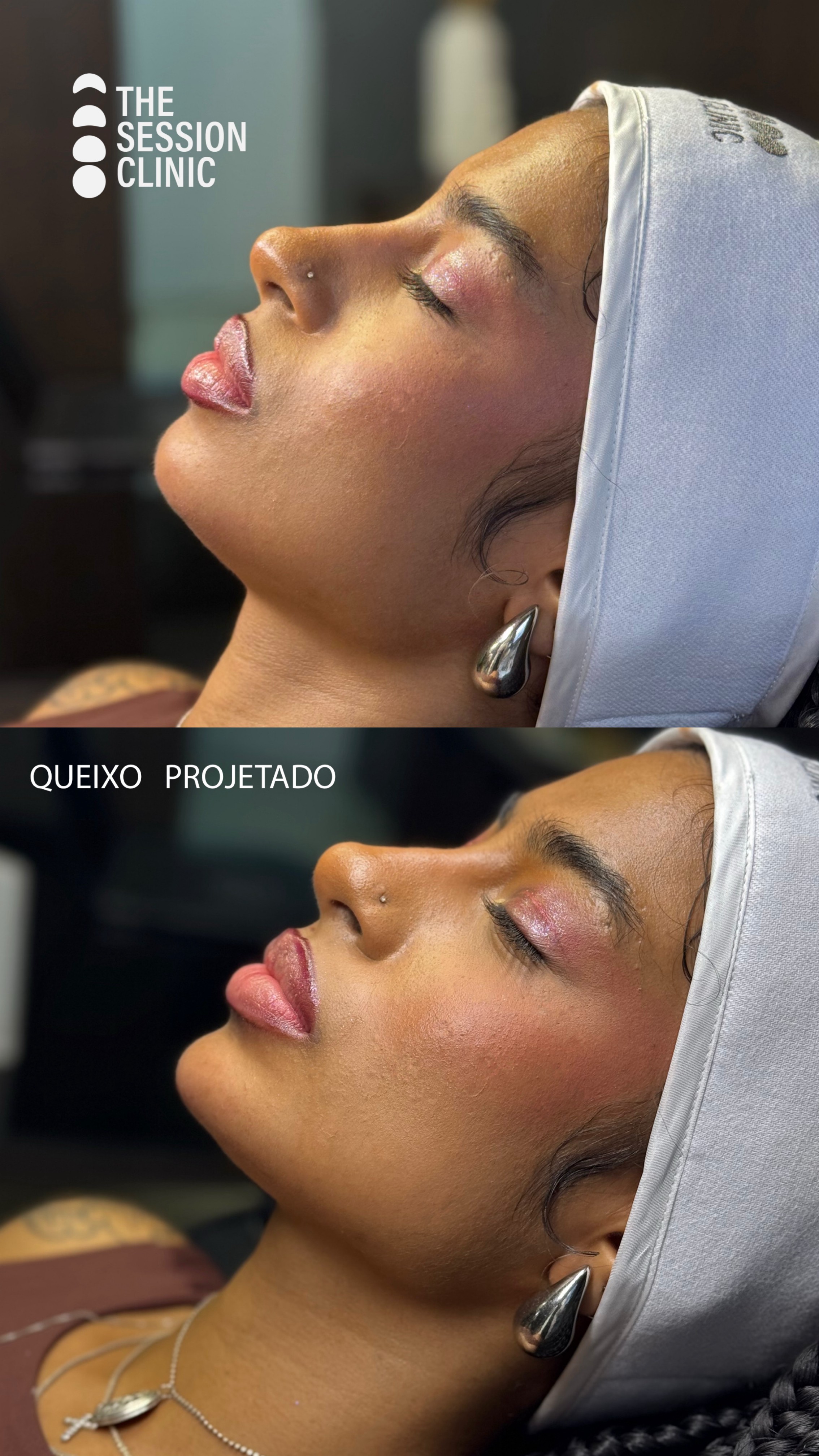 Antes (em cima) e depois (embaixo) — Preenchimento com ácido hialurônico, queixo (mento)