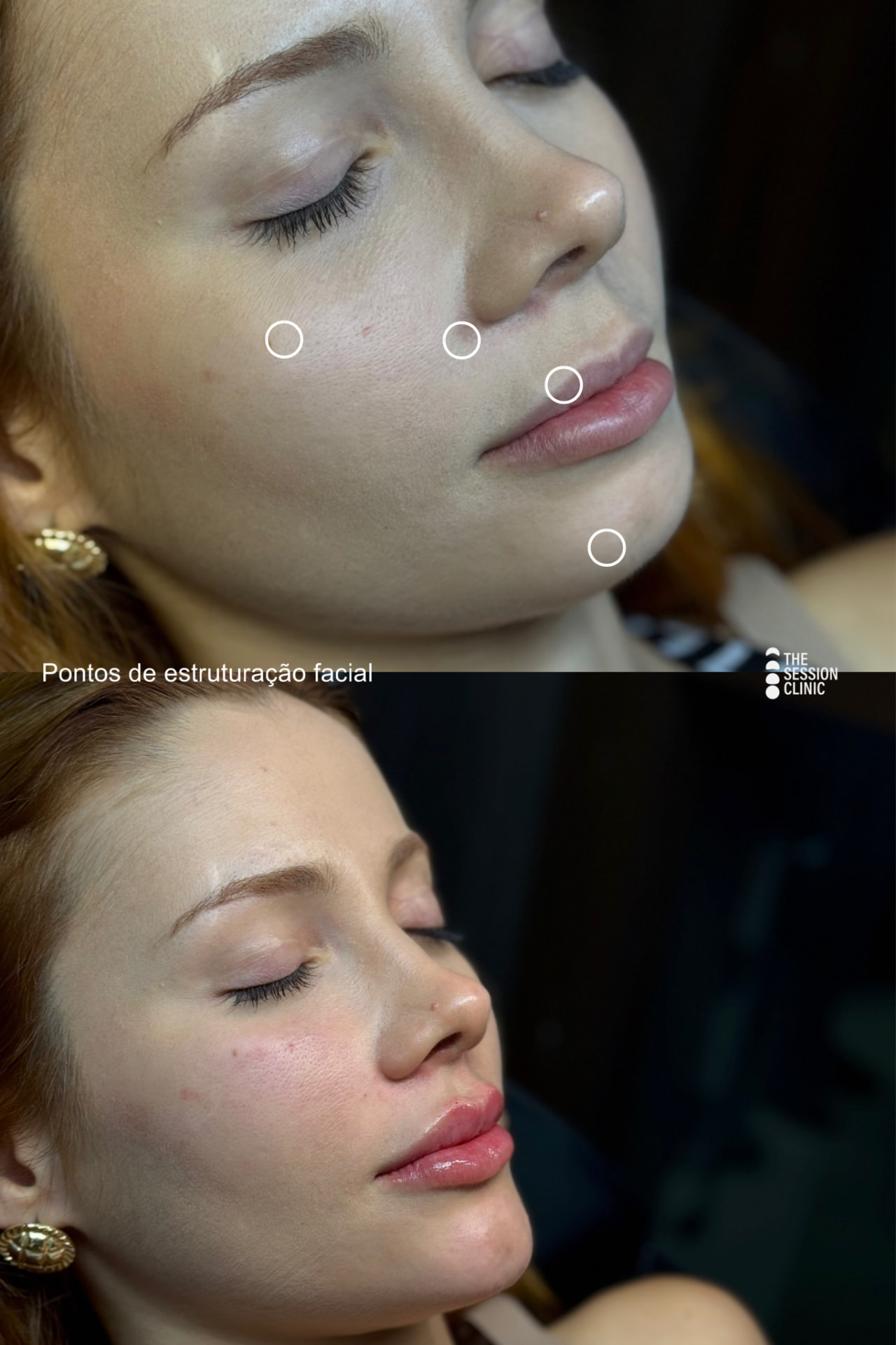 Antes e depois — full face (estruturação facial)