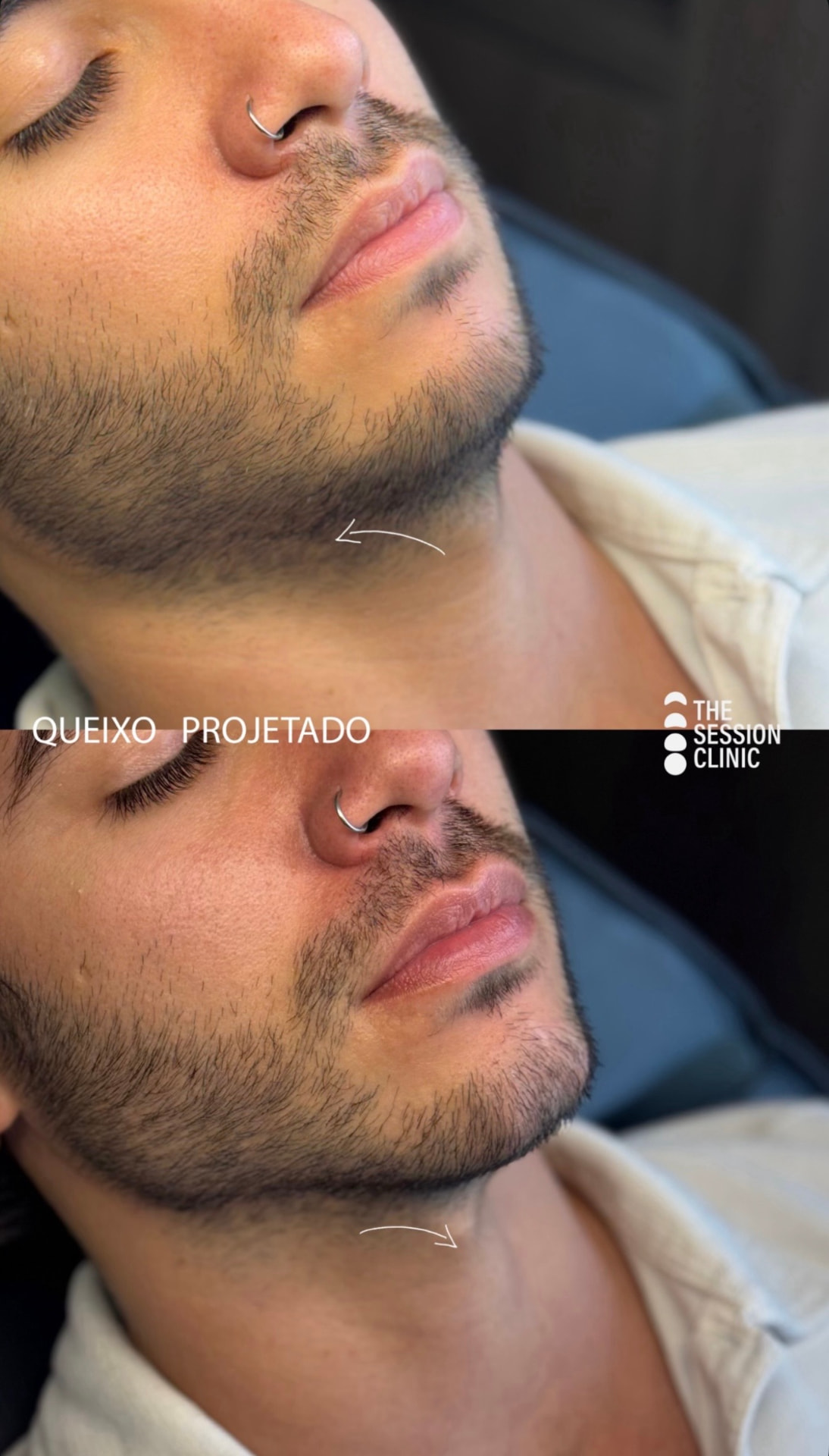 Antes (em cima) e depois (embaixo) — Preenchimento com ácido hialurônico, queixo (mento)