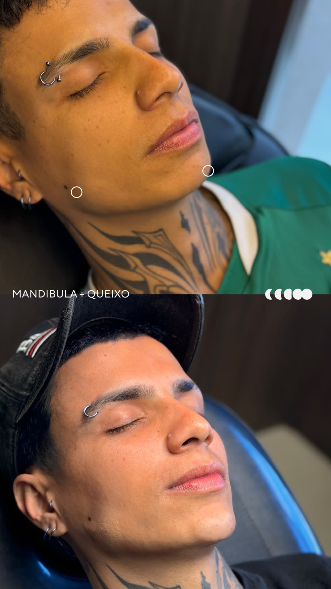 Antes (em cima) e depois (embaixo) — Preenchimento com ácido hialurônico, mandíbula e queixo (mento)