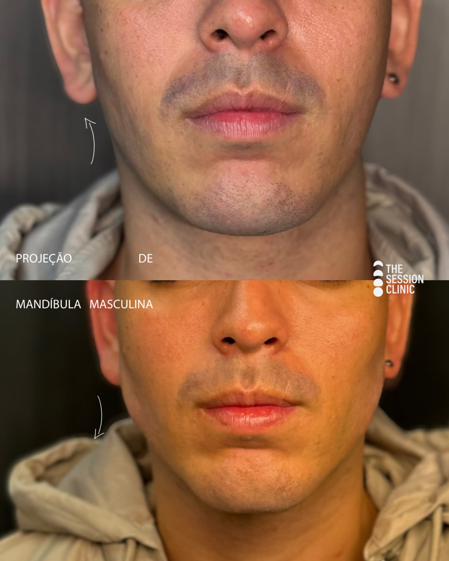Antes (em cima) e depois (embaixo) — mandíbula