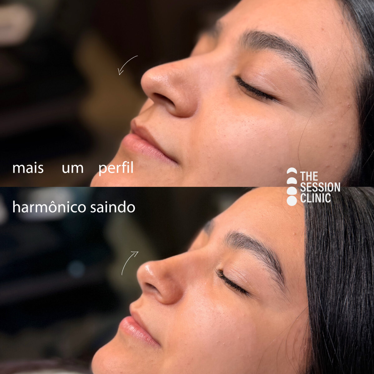 Antes (em cima) e depois (embaixo) — Preenchimento com ácido hialurônico, nariz (rinomodelação)