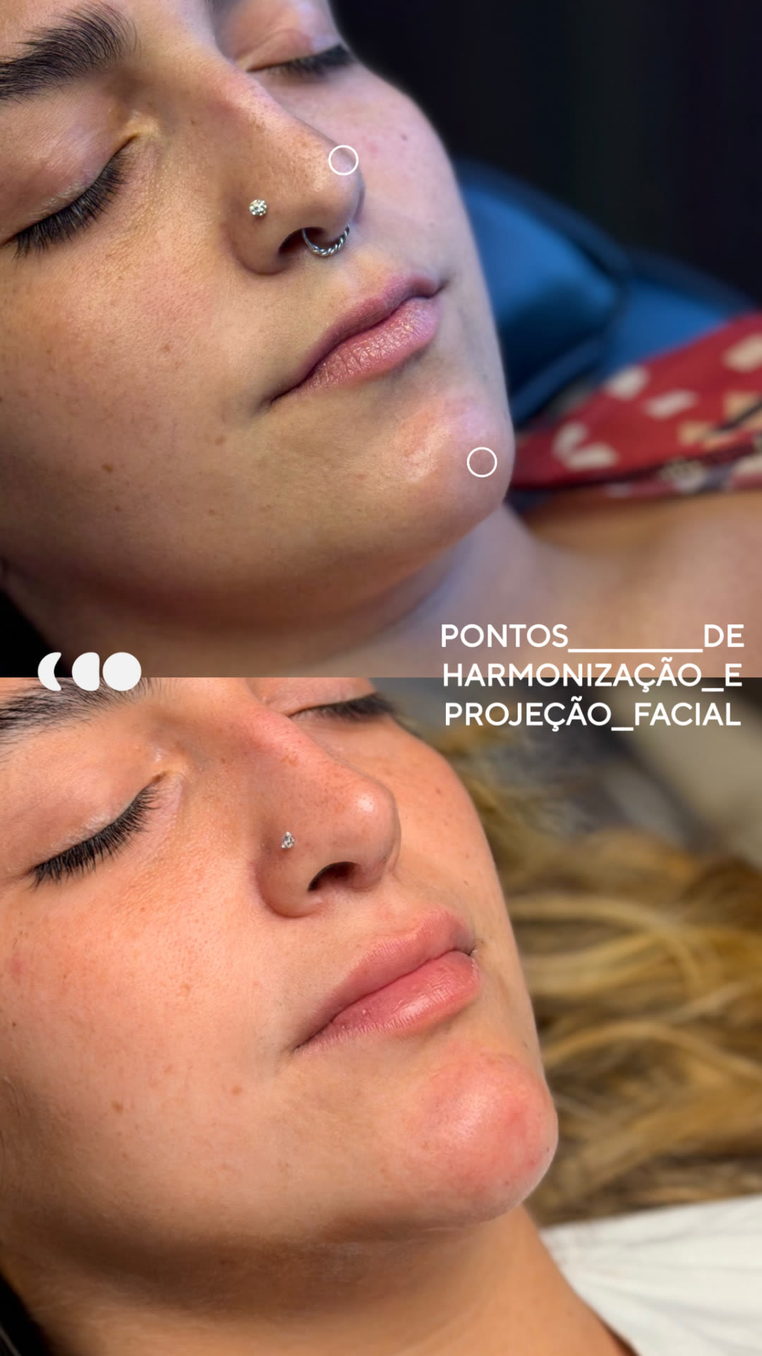 Antes (em cima) e depois (embaixo) — Preenchimento com ácido hialurônico, nariz e mento (projeção facial)