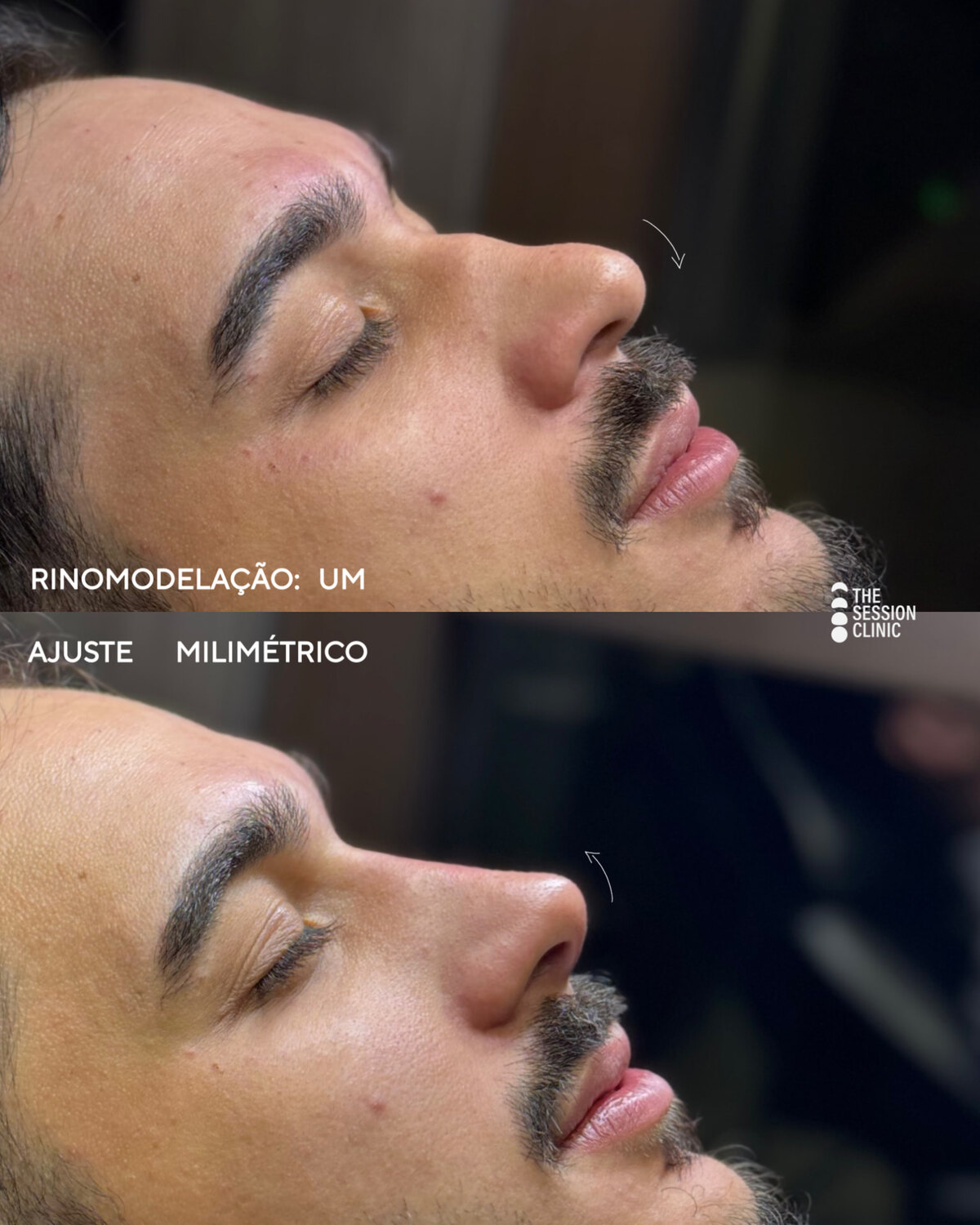 Antes (em cima) e depois (embaixo) — Preenchimento com ácido hialurônico, nariz (rinomodelação)