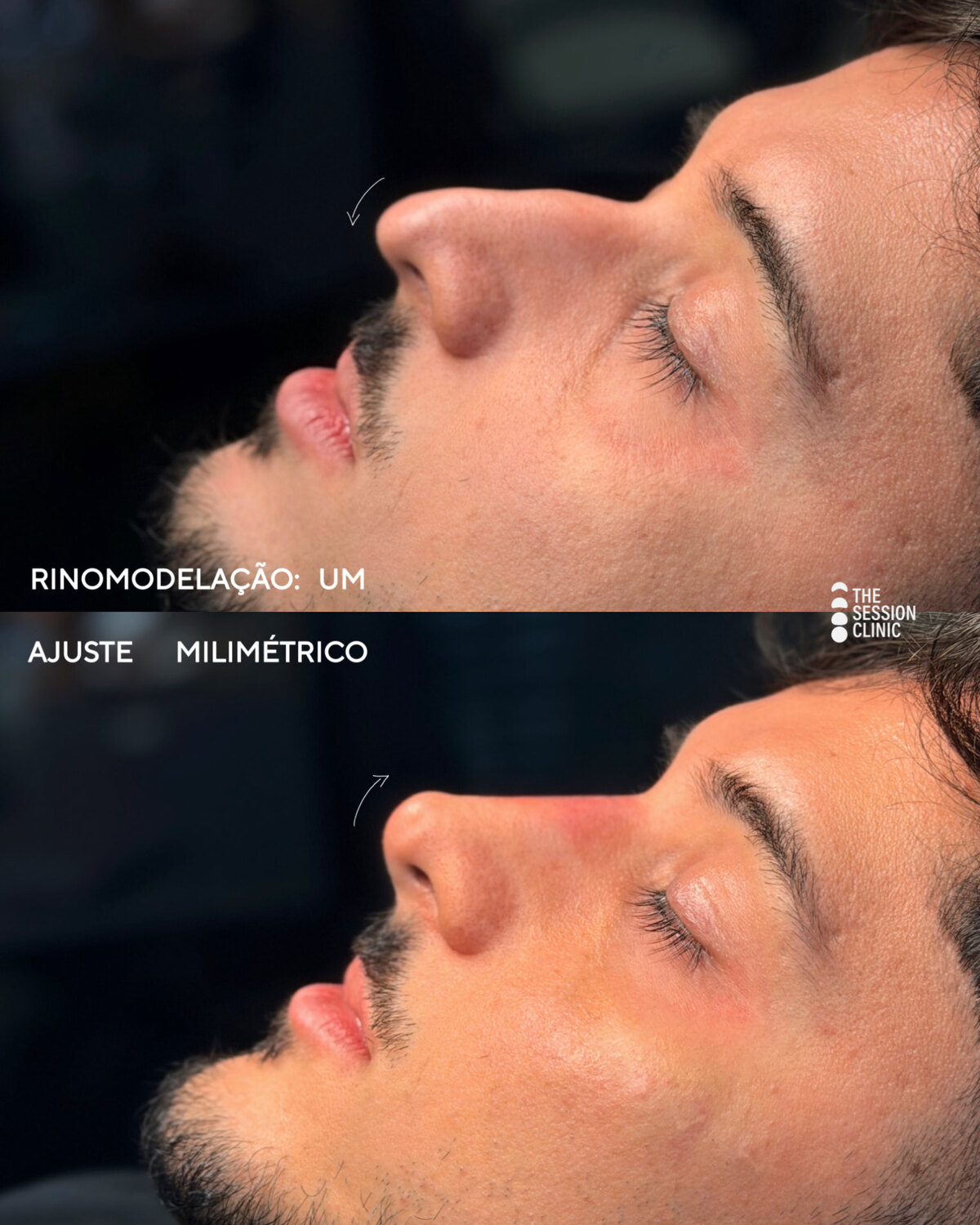 Antes (em cima) e depois (embaixo) — Preenchimento com ácido hialurônico, nariz (rinomodelação)