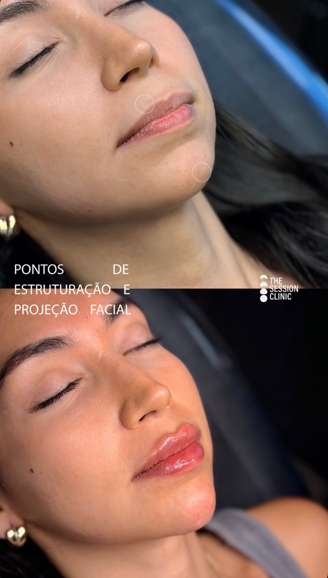 Antes (em cima) e depois (embaixo) — Preenchimento com ácido hialurônico, lábios e mento (estruturação e projeção)