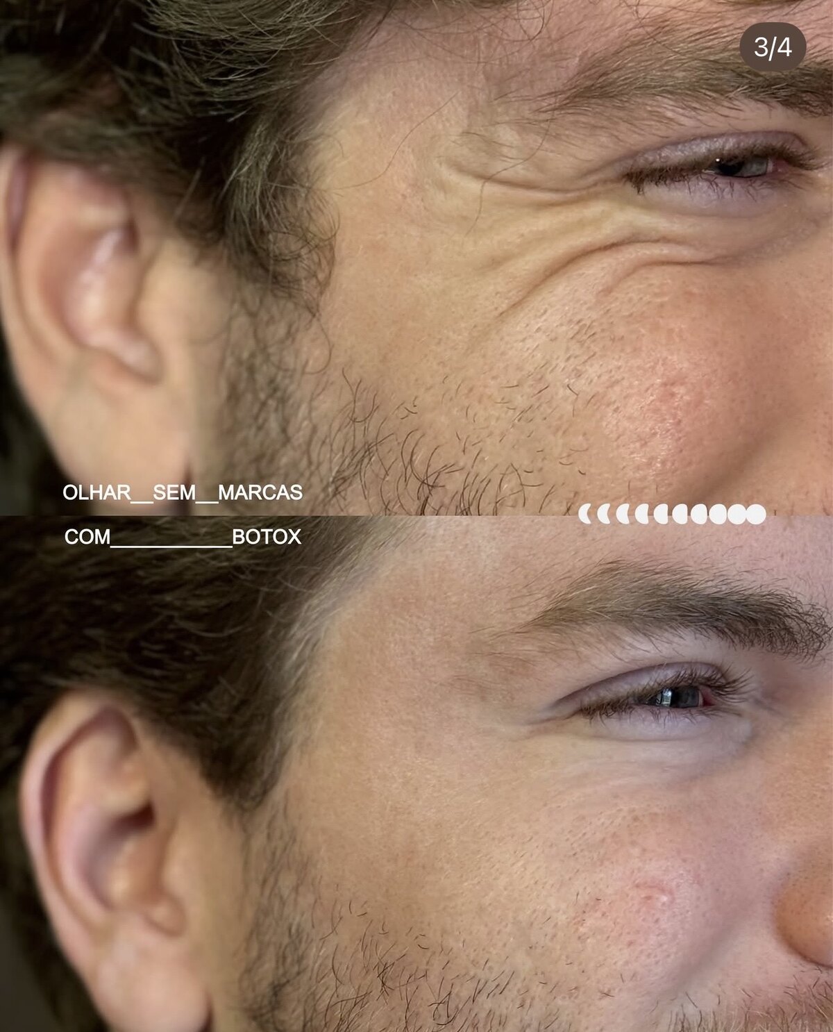 Antes (em cima) e depois (embaixo) — Toxina botulínica, região dos olhos