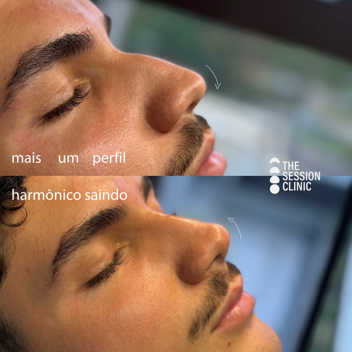 Antes (em cima) e depois (embaixo) — Preenchimento com ácido hialurônico, nariz (rinomodelação)