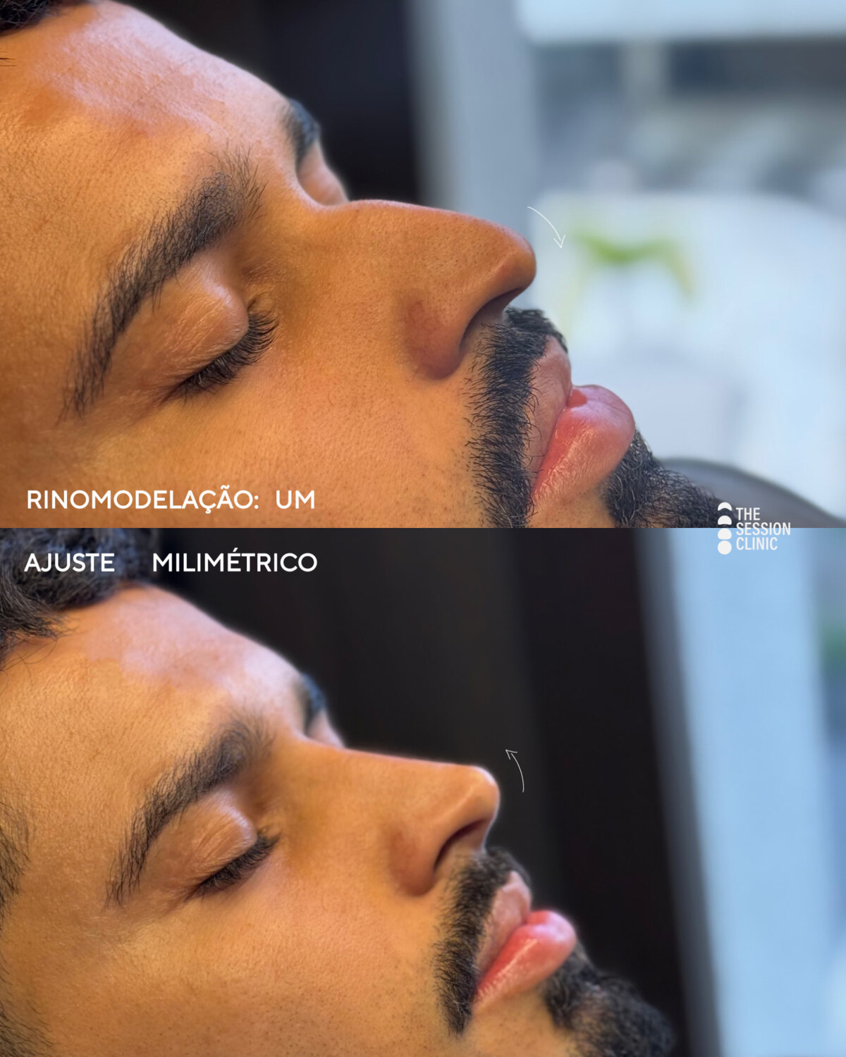 Antes (em cima) e depois (embaixo) — nariz (rinomodelação)