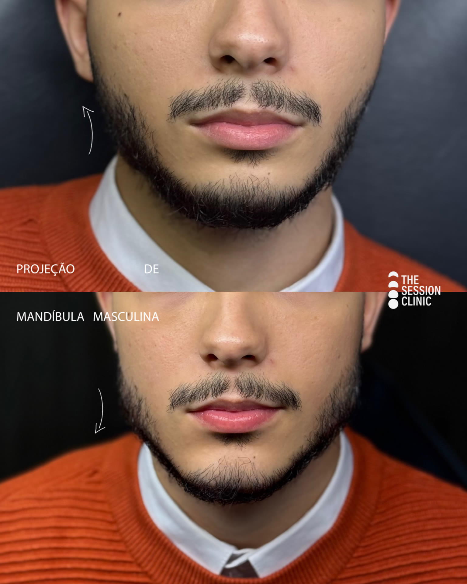 Antes (em cima) e depois (embaixo) — Preenchimento com ácido hialurônico, mandíbula