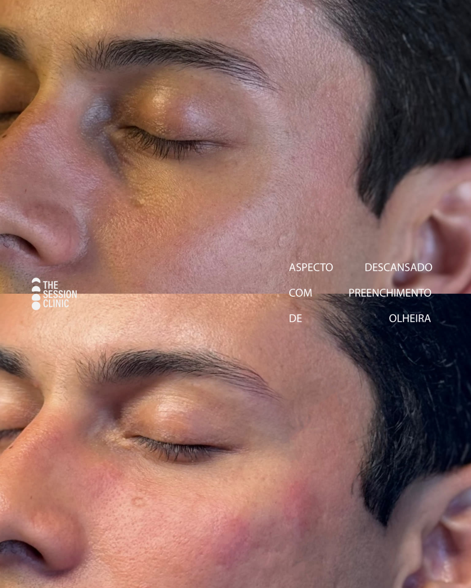 Antes (em cima) e depois (embaixo) — Preenchimento com ácido hialurônico, olheiras
