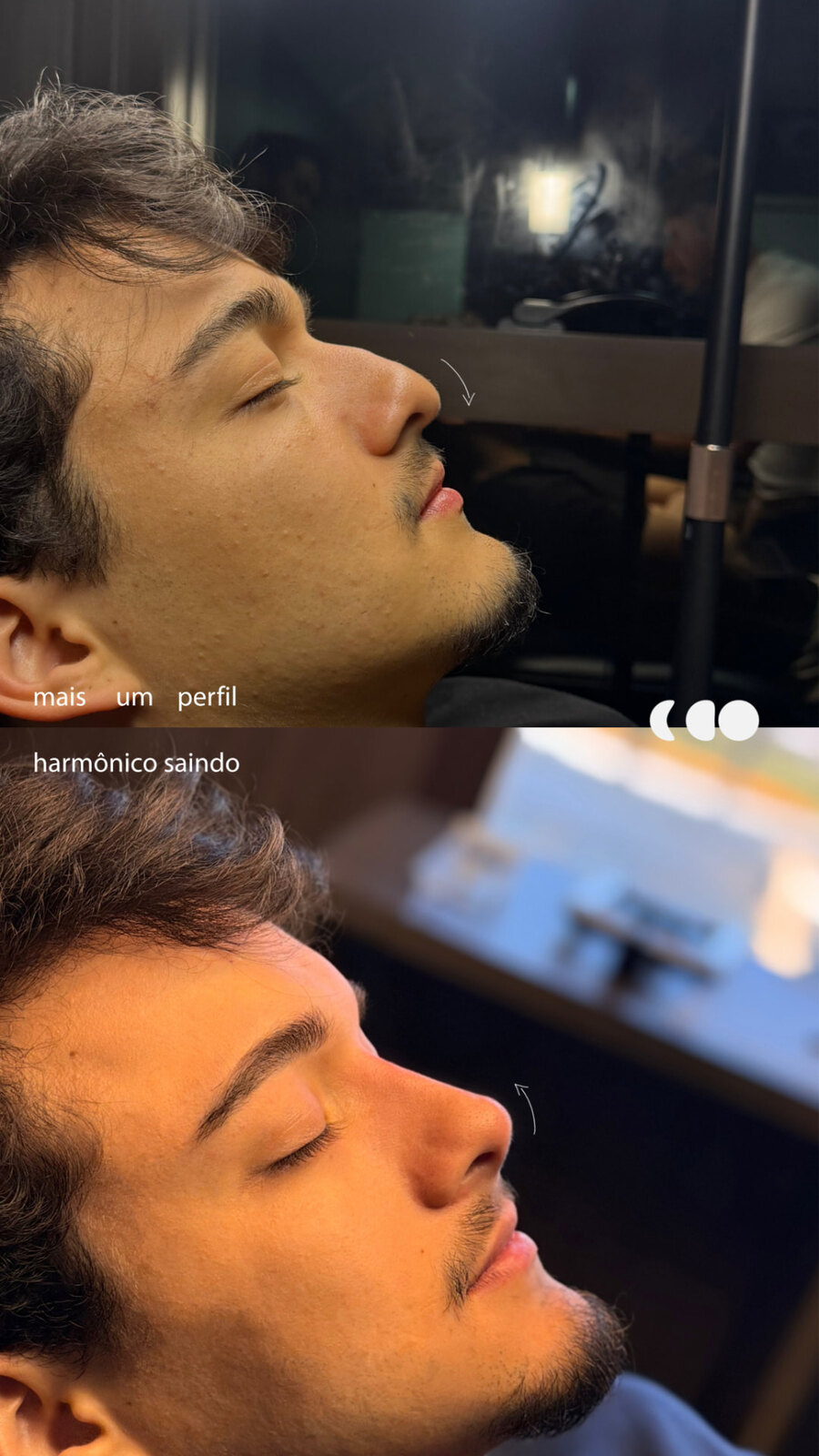 Antes (em cima) e depois (embaixo) — Preenchimento com ácido hialurônico, nariz (rinomodelação)
